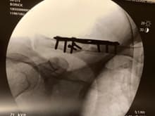 8 screws, 2 plates to put humpty back together again