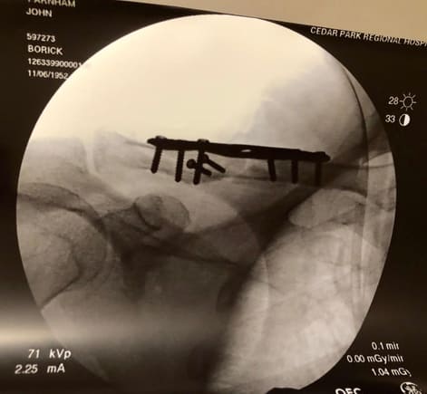 8 screws, 2 plates to put humpty back together again