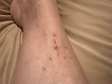 I’m so extremely allergic I scratch until I break the skin then put alcohol and finally the itching stops. I’m a medical provider, I realize this makes me prone to getting an infection.  But the itching is intense. No amount of steroid cream or Benadryl cream helps. 