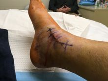Cast change after surgery in Palo Alto; two lengthy incisions on either side if right ankle.
