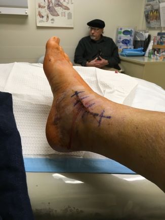Cast change after surgery in Palo Alto; two lengthy incisions on either side if right ankle.