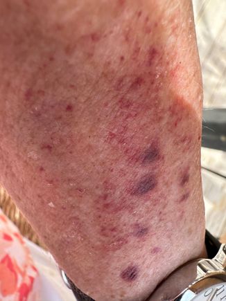 A dotty arm.....what in the world are these spots??