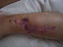 Fixator Removed only to find out I have osteomyelitis - December 2009
