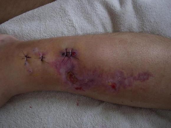 Fixator Removed only to find out I have osteomyelitis - December 2009