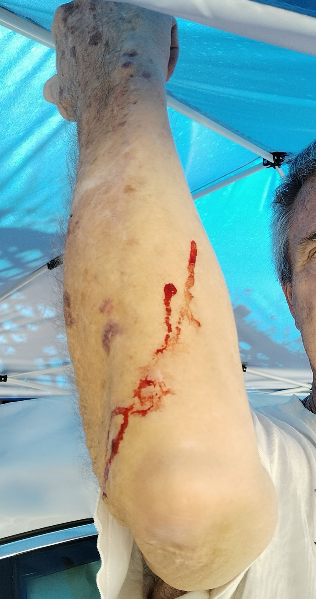 Only ONE bleeding elbow today!