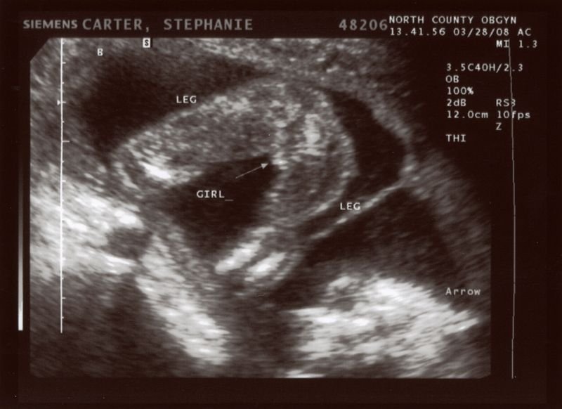 ultrasound dating wrong With transvaginal ultrasound making dating the pregnancy very accurate not that the early crl was wrong fetal heartbeat. ultrasound dating wrong With transvaginal ultrasound making dating the pregnancy very accurate not that the early crl was wrong fetal heartbeat.