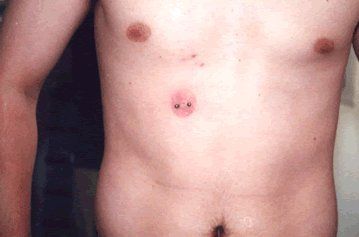 surfacethirdnipple.jpg